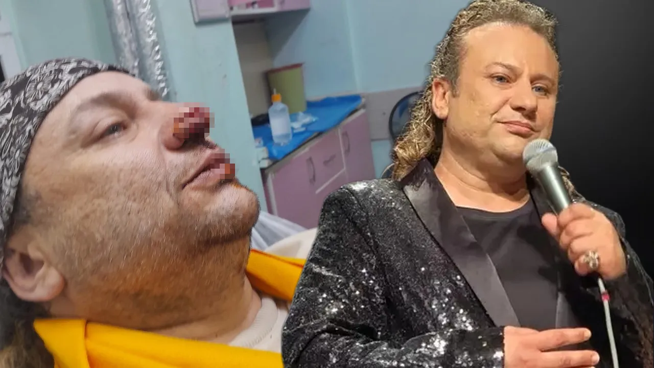 Onur Akay pitbull saldırısında yaralandı! Burnundan parça koptu