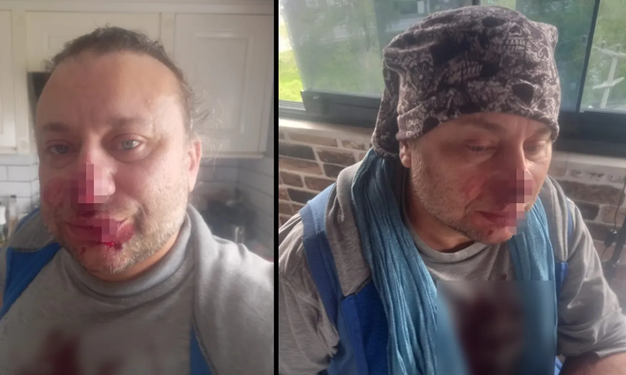 Onur Akay pitbull saldırısında yaralandı! Burnundan parça koptu