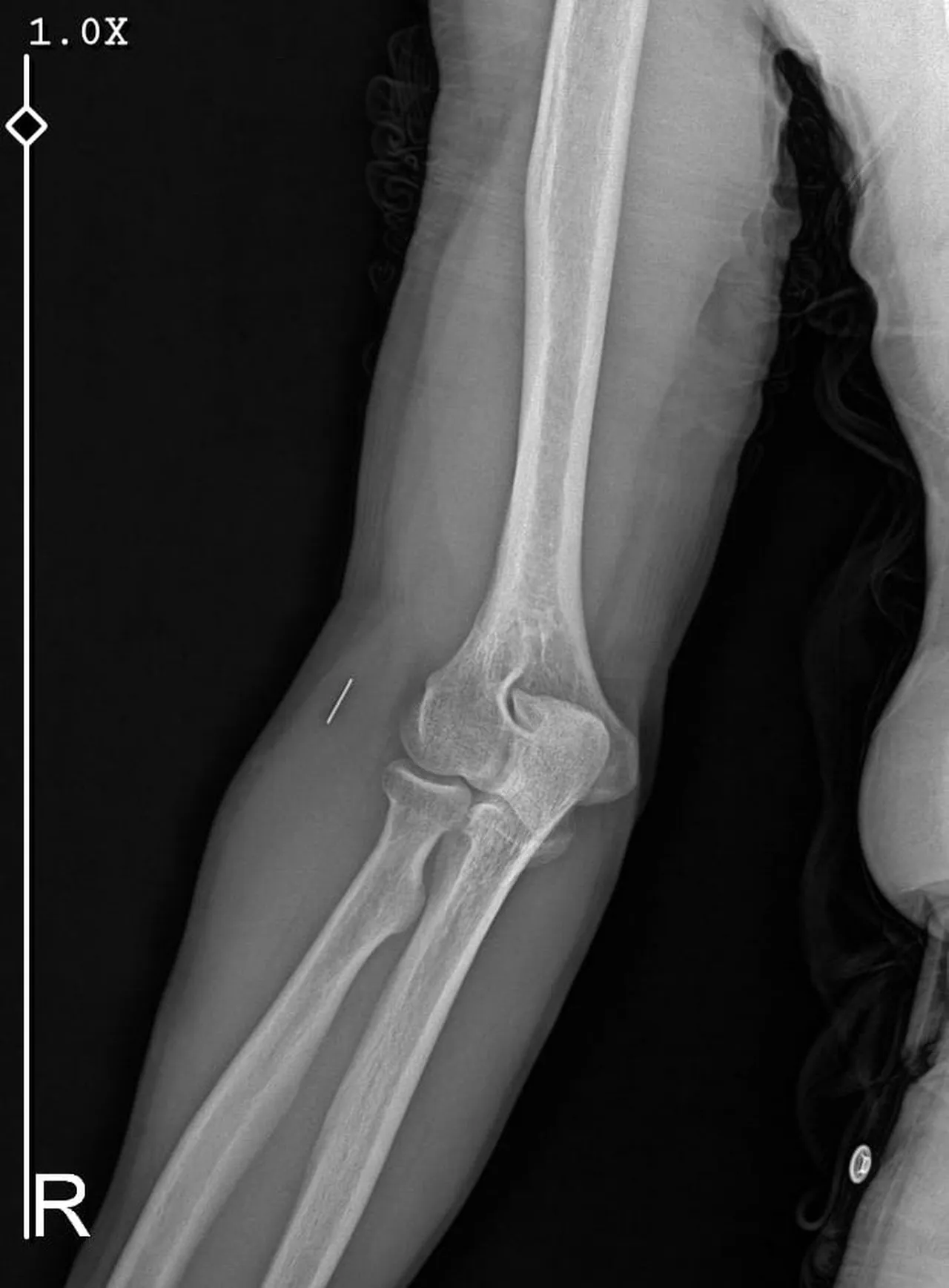 Basit bir bıçak kesiği hayatını kabusa çevirdi! Önce çürüdü sonra parmağını kaybetti