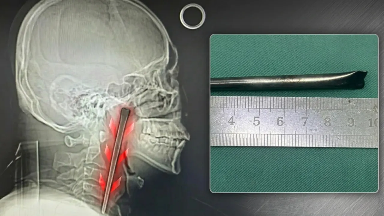 Akıllara durgunluk veren ihmal! 8 yıl boyunca boğazında metal çubukla yaşadı