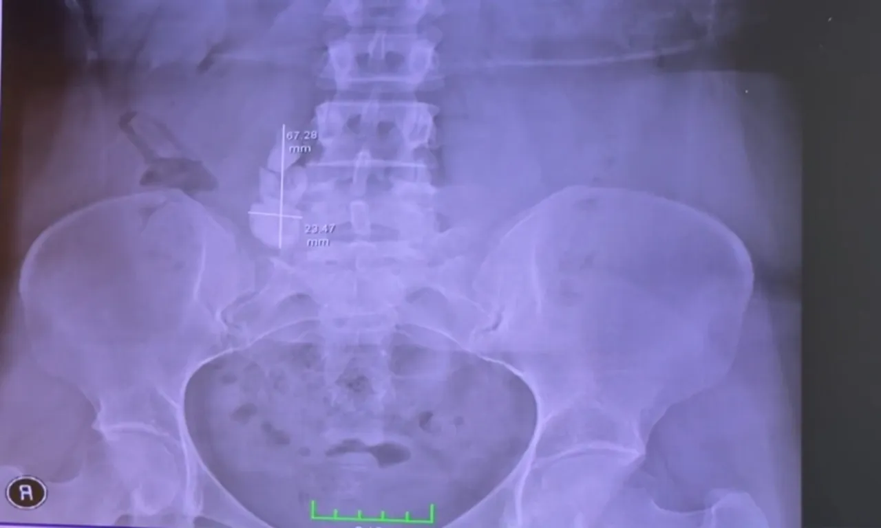 Dayanılmaz ağrıyla her gün acile gidiyordu! Gerçek sebep ameliyatta ortaya çıktı