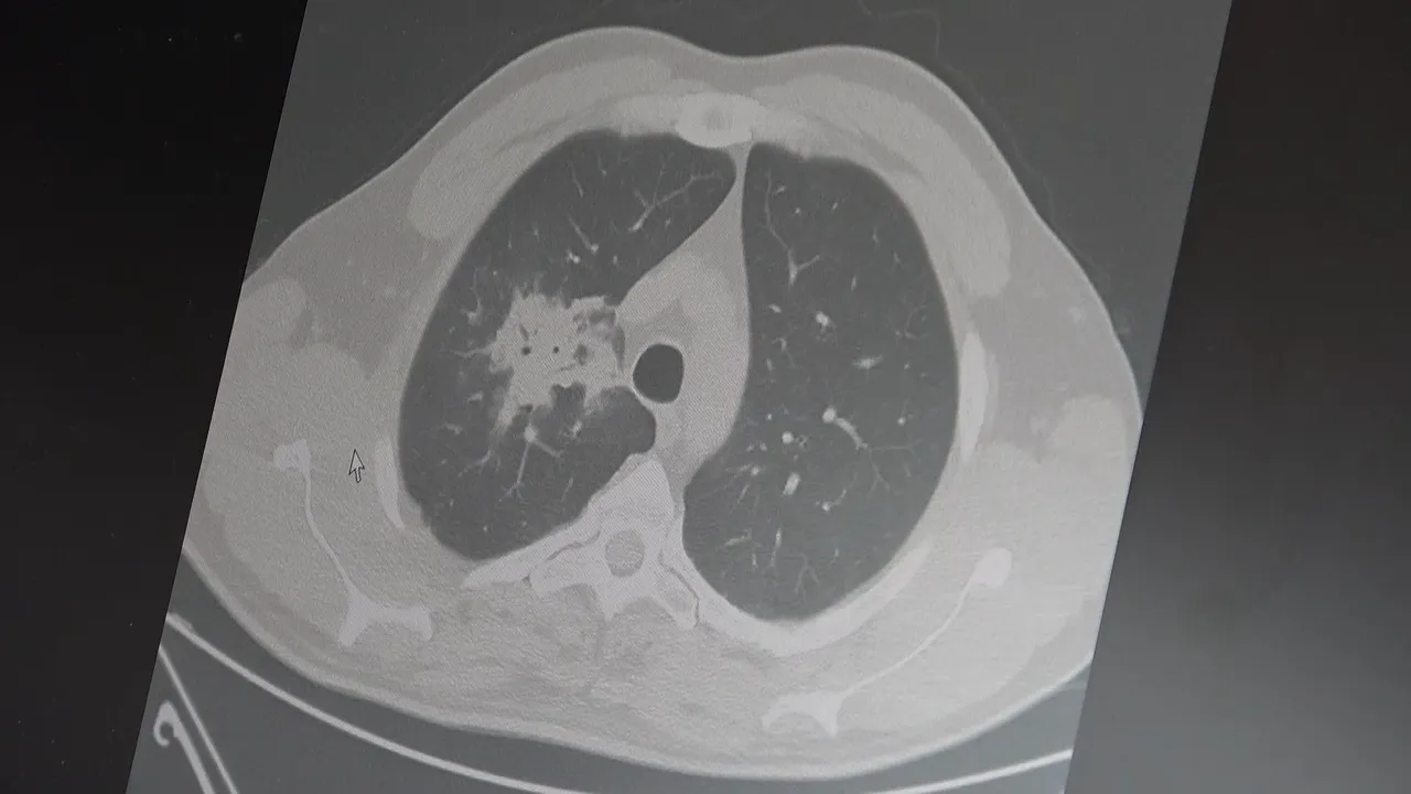 'Hazır olun' diyerek uyardılar: Kanser patlamış mısır gibi yayılacak