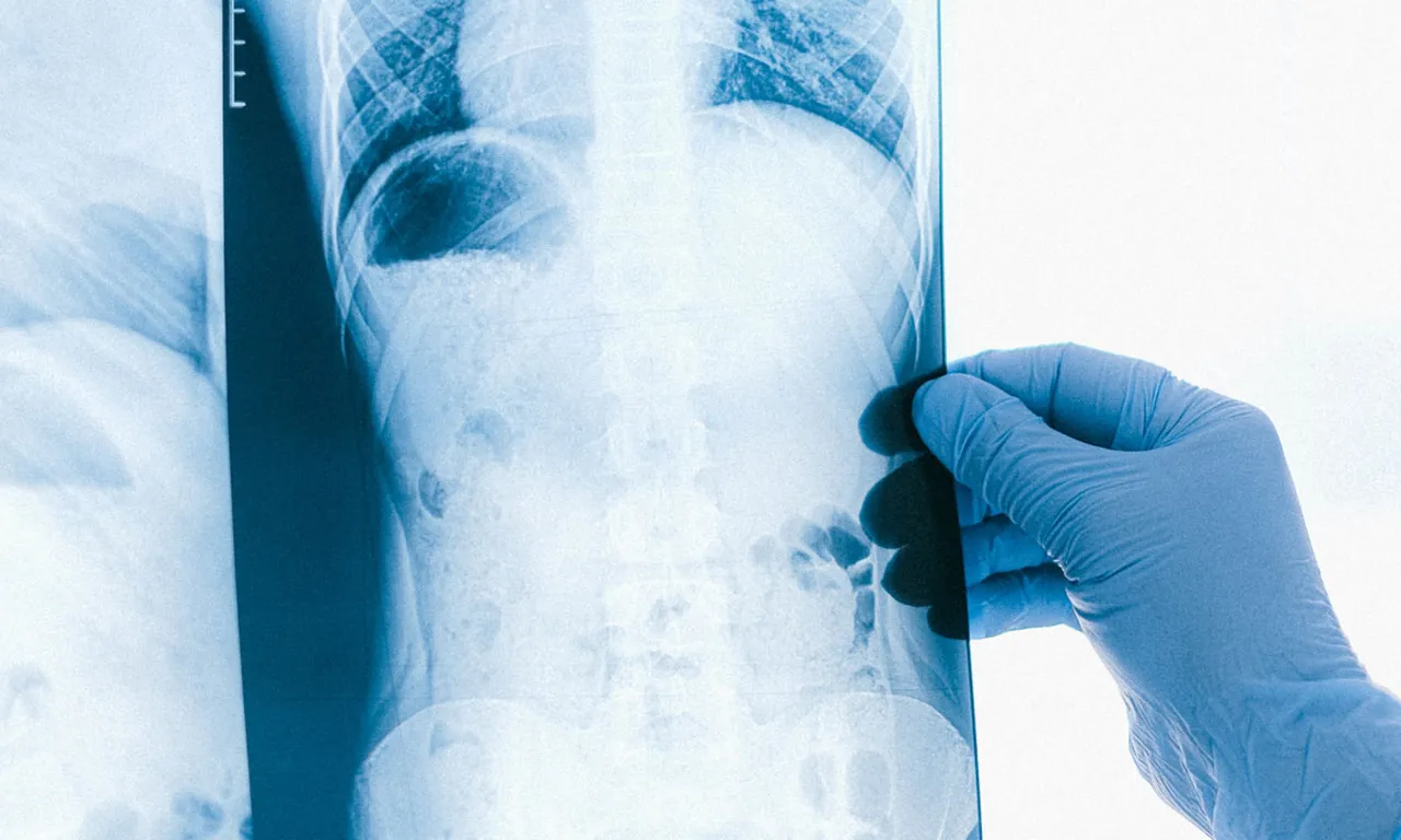 Milyonda 7 kişide görülen hastalık! Göğüs ağrısı diye gitti, gerçek başka çıktı 