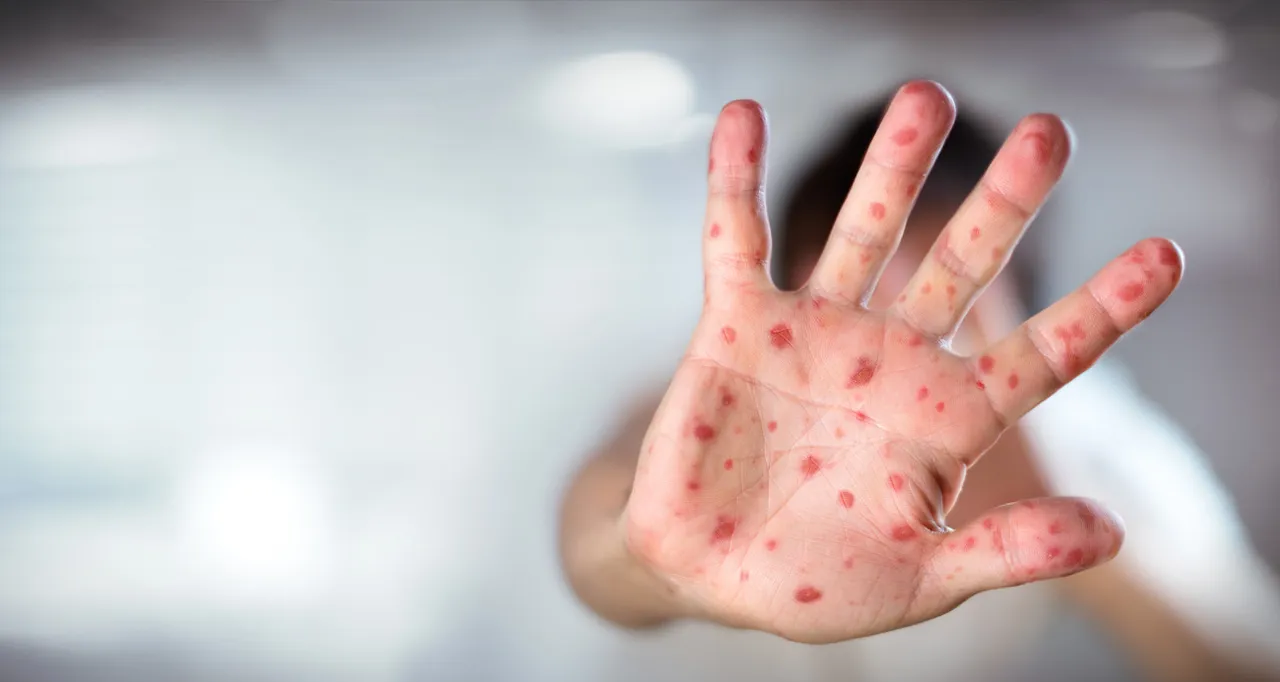 10 kişiden 9’una bulaşıyor! Kızamık Avrupa’yı sarstı, Türkiye’de son durum ne? Açıklama geldi: Şu an risk yok