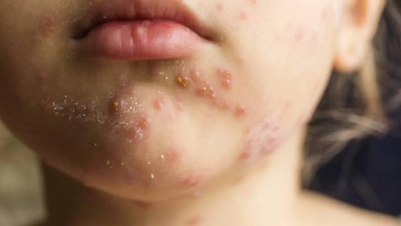 10 kişiden 9’una bulaşıyor! Kızamık Avrupa’yı sarstı, Türkiye’de son durum ne? Açıklama geldi: Şu an risk yok