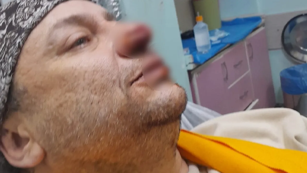 Pitbull saldırısına uğrayan Onur Akay entübe edildi