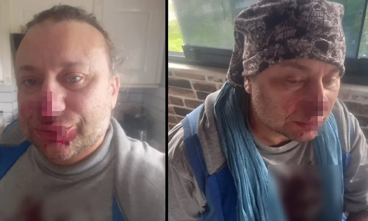 Pitbull saldırısına uğrayan Onur Akay entübe edildi