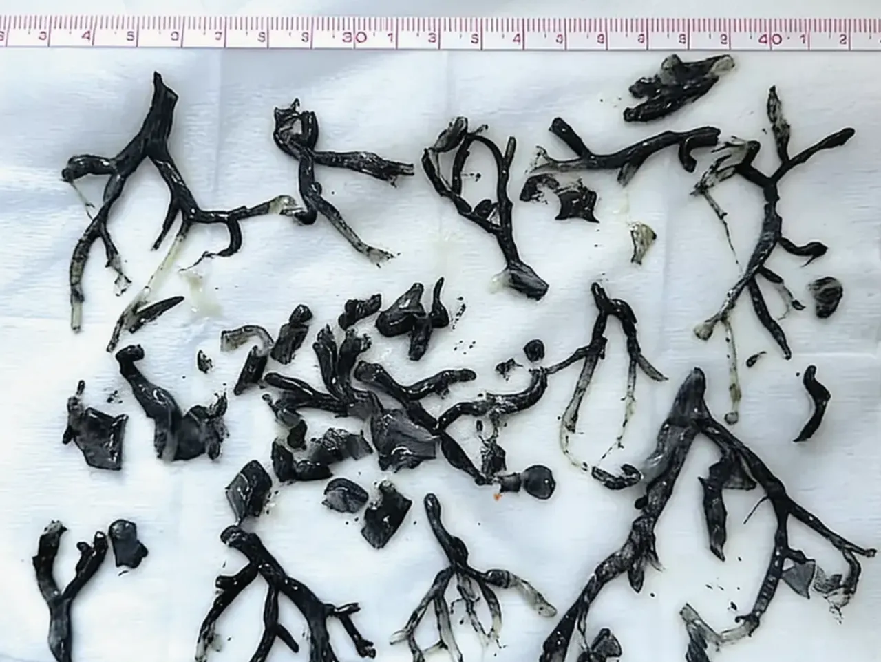 Nefes darlığı şikayetiyle başvurmuştu! Ciğerlerinden çıkanlar doktorları bile şaşkına çevirdi