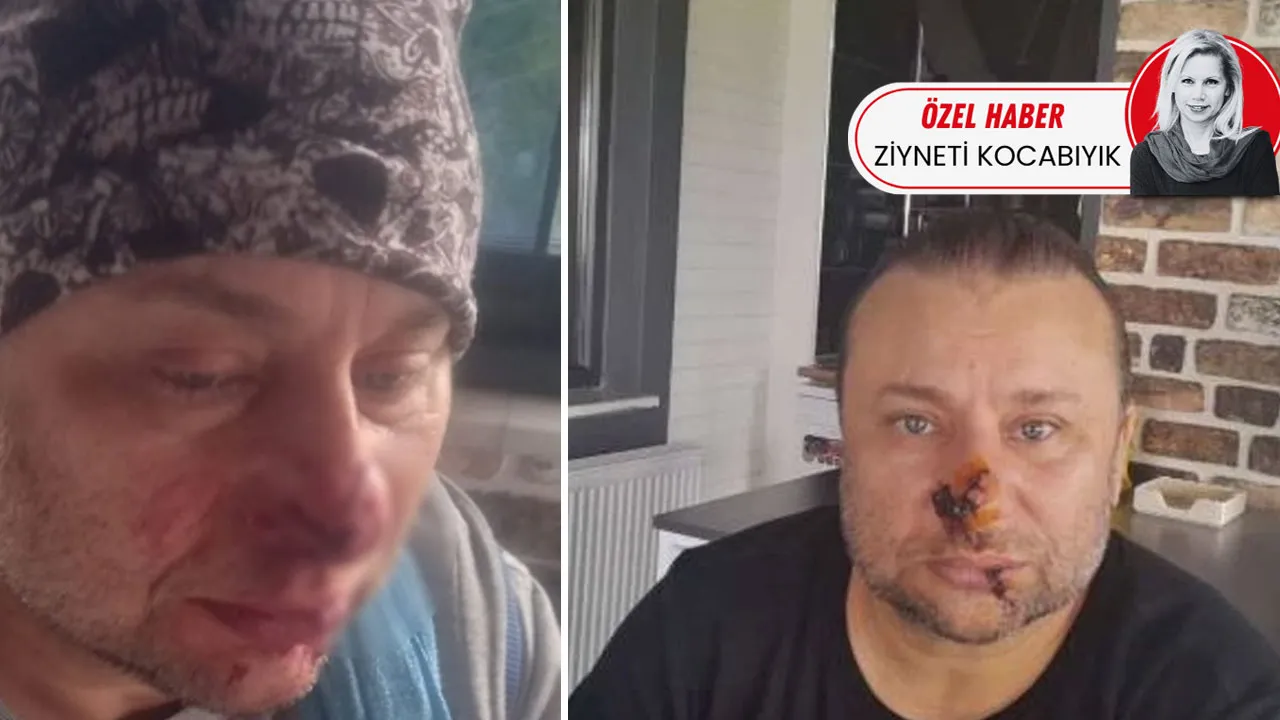 Pitbull ısırdı, et yiyen bakteri iddiası gündeme geldi! Şarkıcı Onur Akay entübe edildi