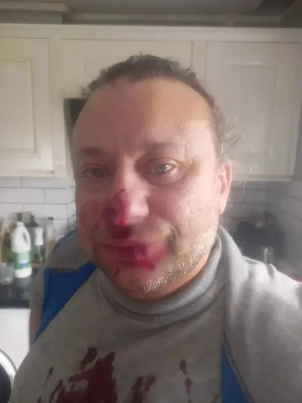 Pitbull ısırdı, et yiyen bakteri iddiası gündeme geldi! Şarkıcı Onur Akay entübe edildi