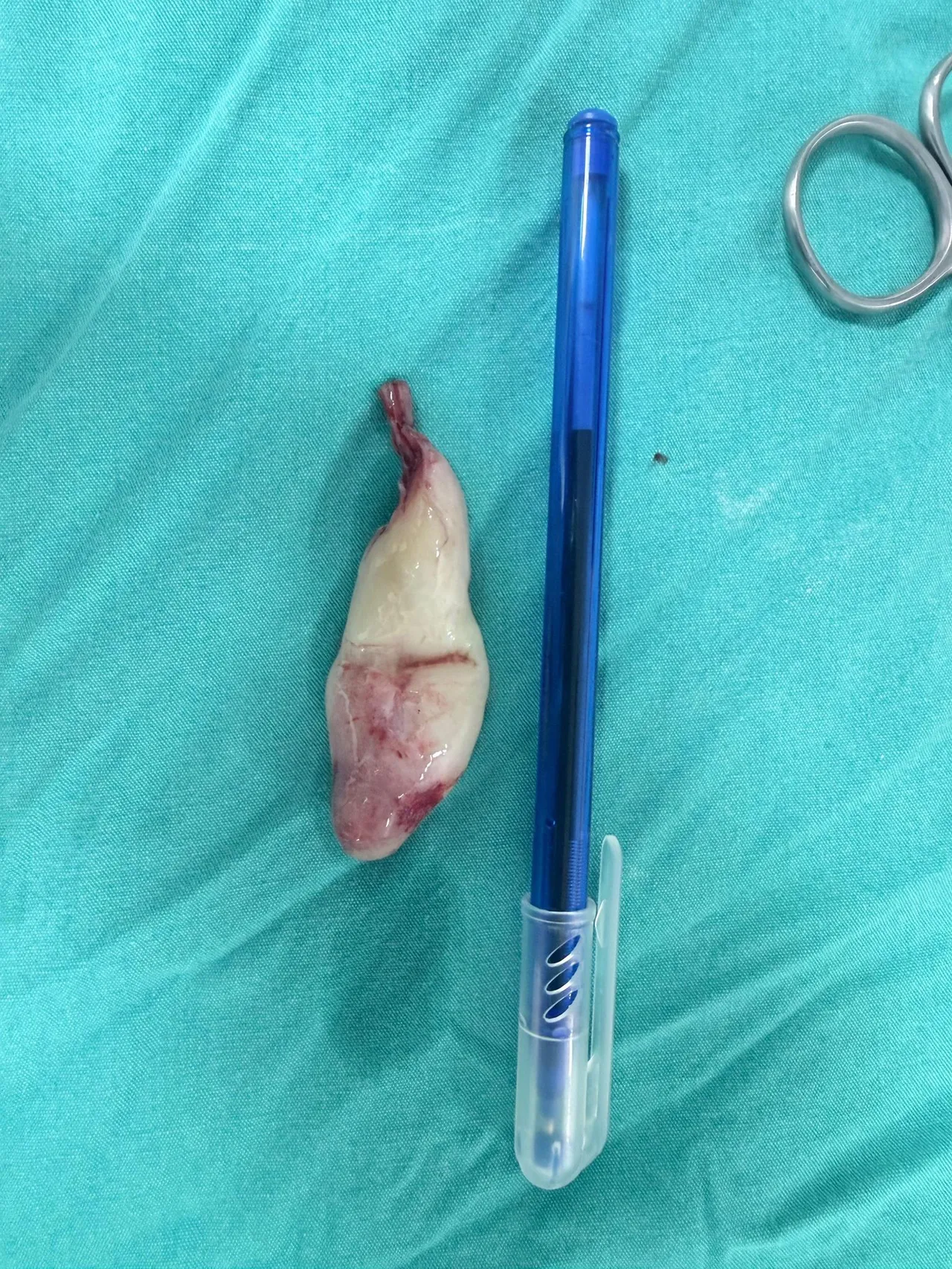 Sebebi ne grip ne de alerji! Burnu tıkandı sandı gerçek bambaşka çıktı! Ağzından çekip aldılar