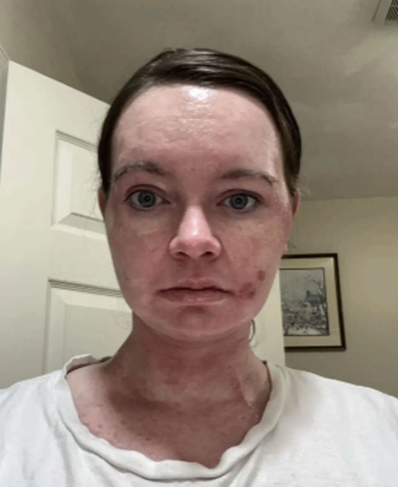 Doktorlar stresten dedi, gerçek bambaşka çıktı! Güneş ışığı en büyük kabusu oldu