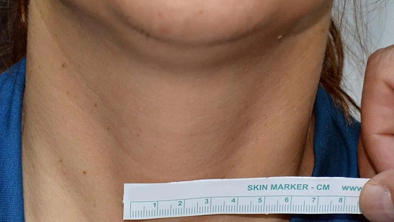 Tiroit tedavisinde bıçaksız devrim: Tümöre dondurarak ya da yakarak tedavi