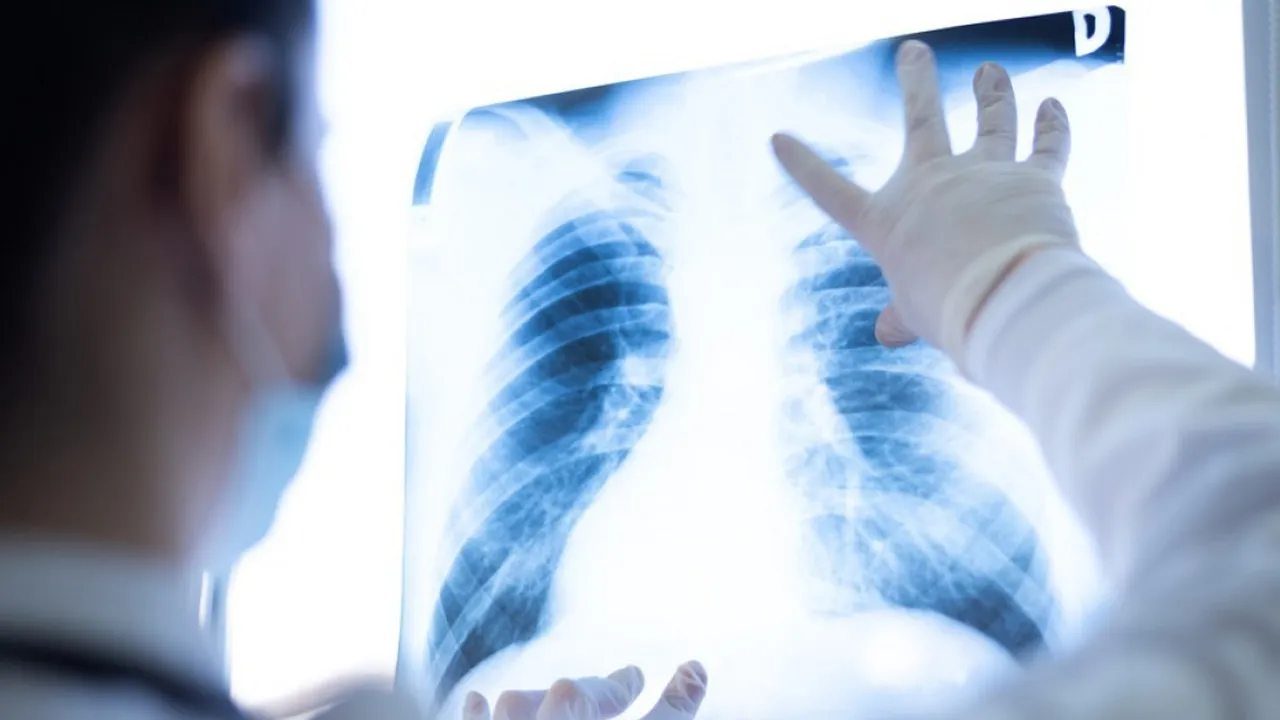 Yılda 35 bin kişi akciğer kanserinden ölüyor: Risk altındakiler özellikle dikkat