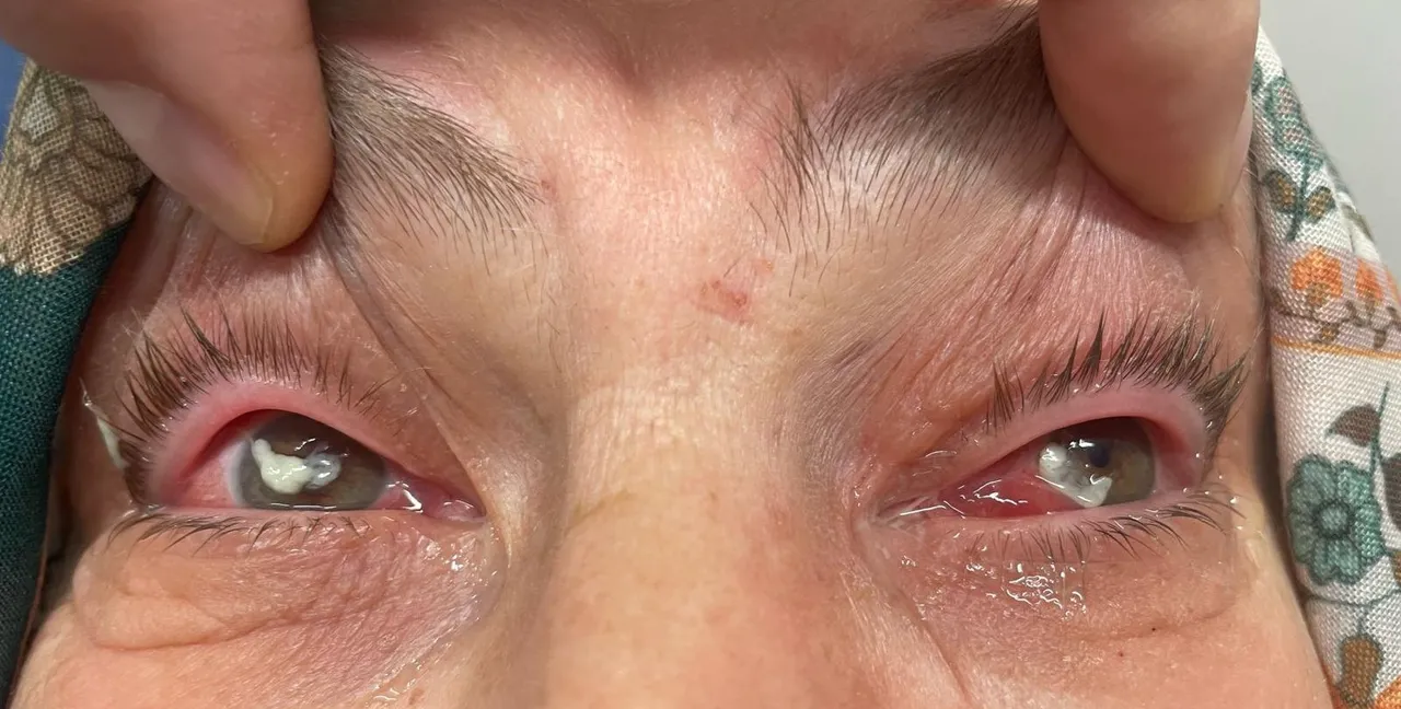 2 damlası kör edecekti! Kırlangıç otu felaketi, sosyal medyadaki viral yöntem hastanelik etti