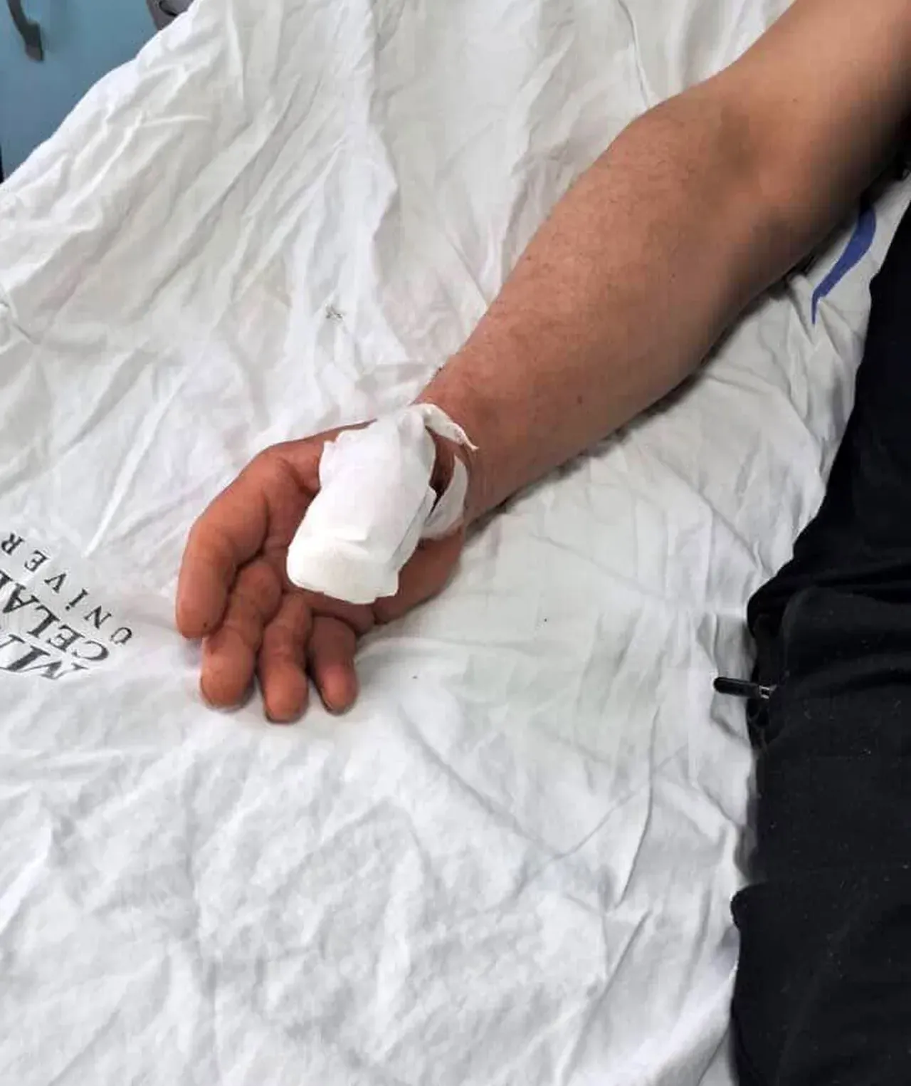 Başıboş köpek saldırısında parmağı koptu! Ameliyatta daha kötüsü başına geldi