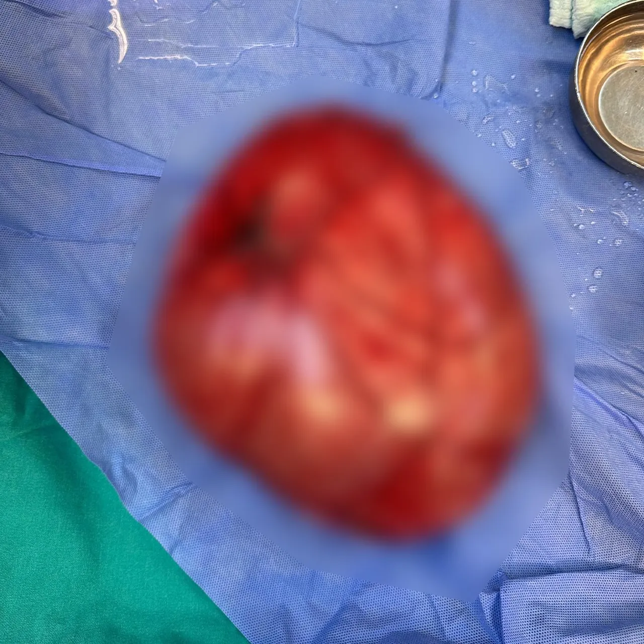 Kilo vermek için 3,5 kilogramlık kist çıkarıldı