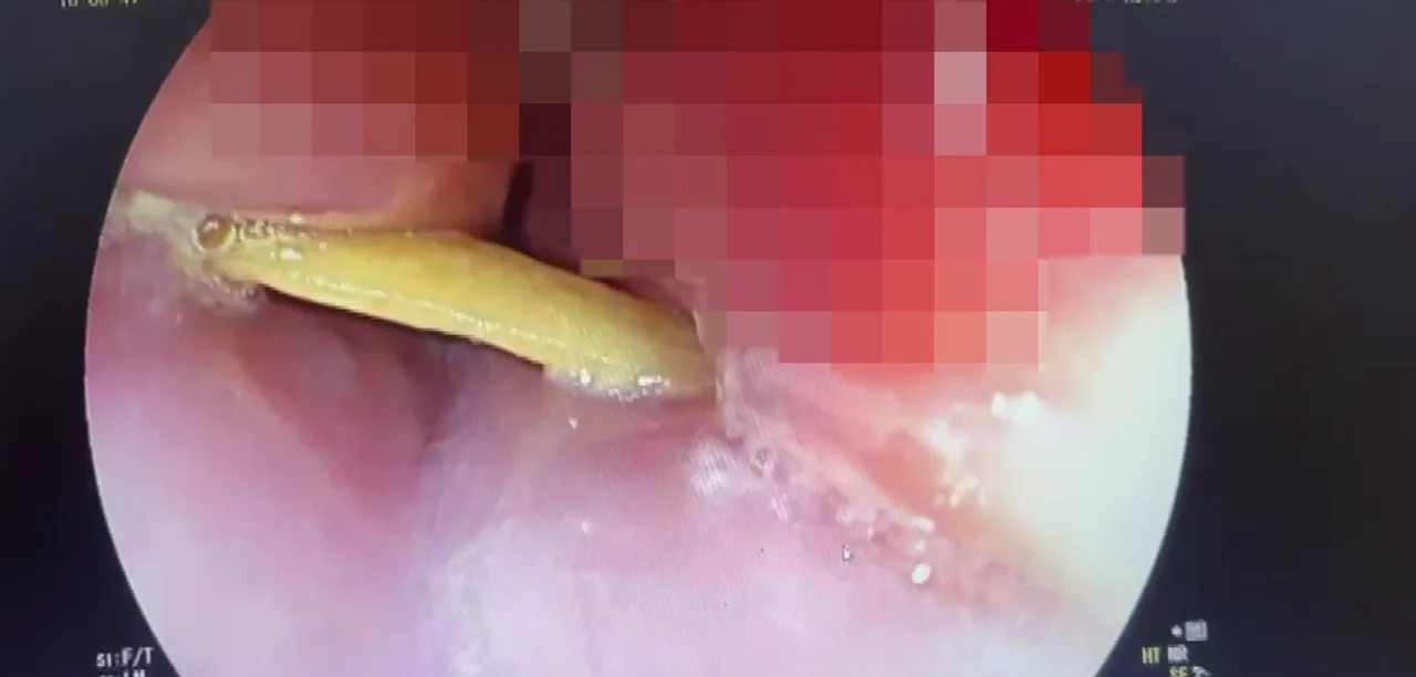 Yemek yerken boğazına kemik saplandı! Ölümün kıyısından döndü