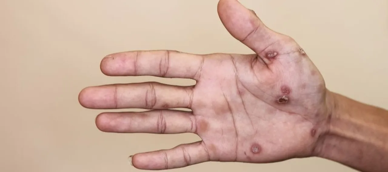 Türklerin en çok ziyaret ettiği Avrupa ülkesinde salgın alarmı! Vakalar rekor seviyeye yükseldi