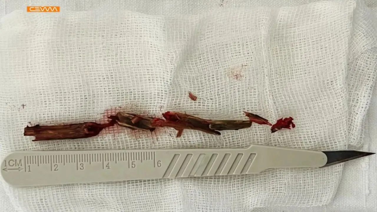 Yaşlı adamın kafatasından ağaç dalı çıktı! Doktorlar bile gözlerine inanamadı
