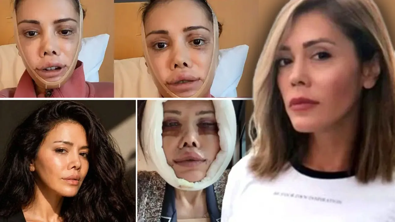 Yüzünü değiştirmek için 15 saat ameliyat olmuştu! Didem Ceran çileden çıktı...
