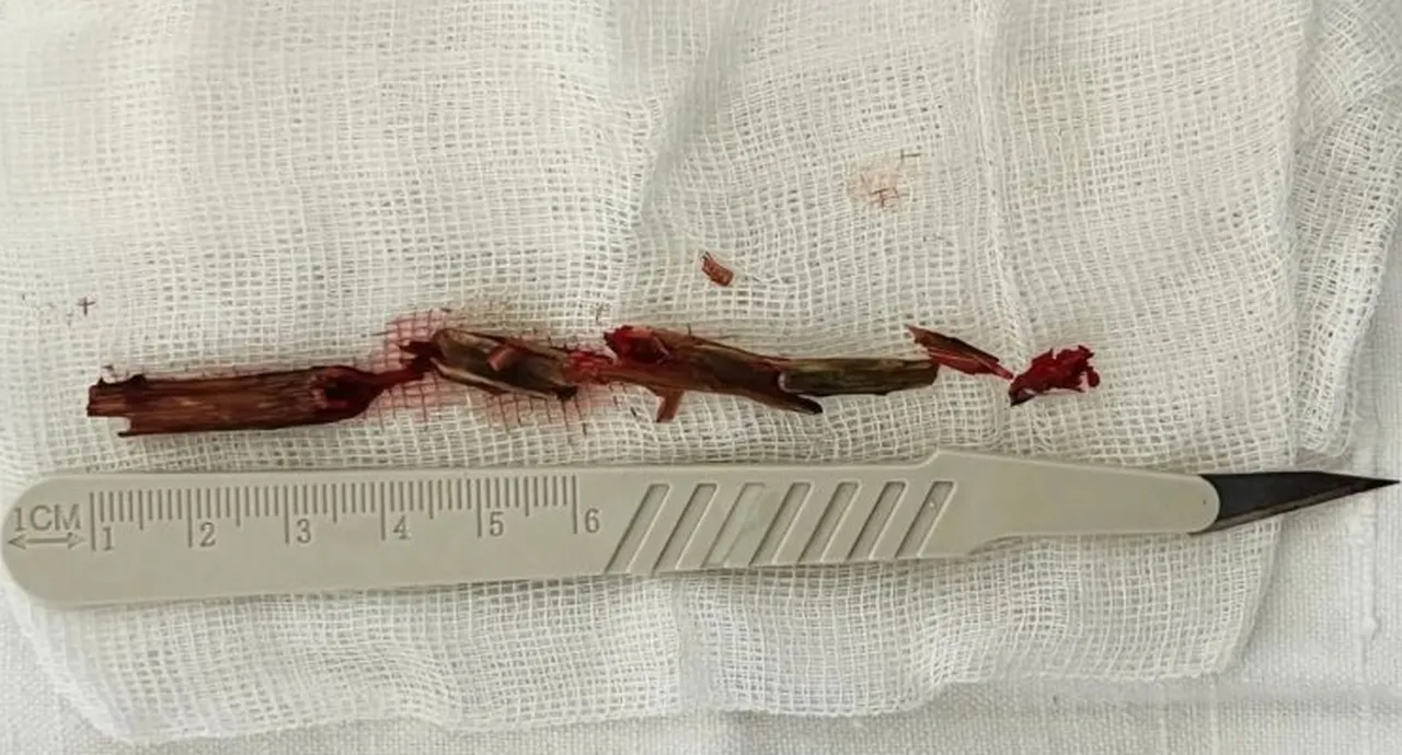 Aylarca göz ağrısı çekti, kafatasından ağaç dalı çıkarıldı! Doktorları şaşkına çeviren olay