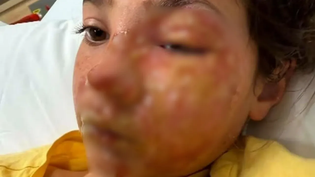 TikToktaki ısıtma akımı kabusu yaşattı! Oyuncak yüzüne patladı, neye uğradığını şaşırdı