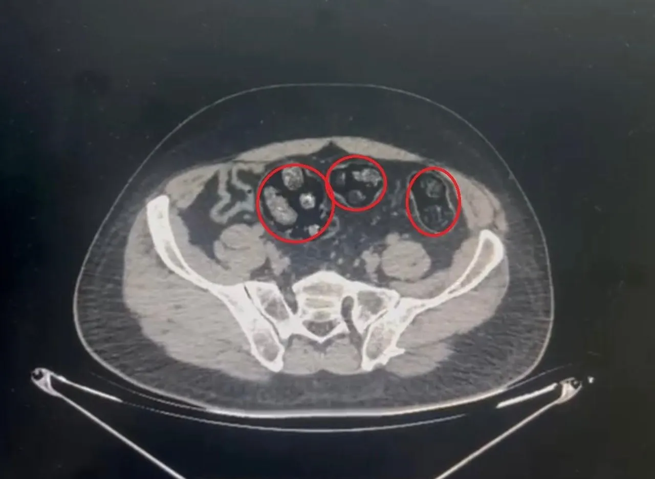 Yolcu otobüsüne operasyon! Mide ve bağırsaklarından 62 parça uyuşturucu çıktı