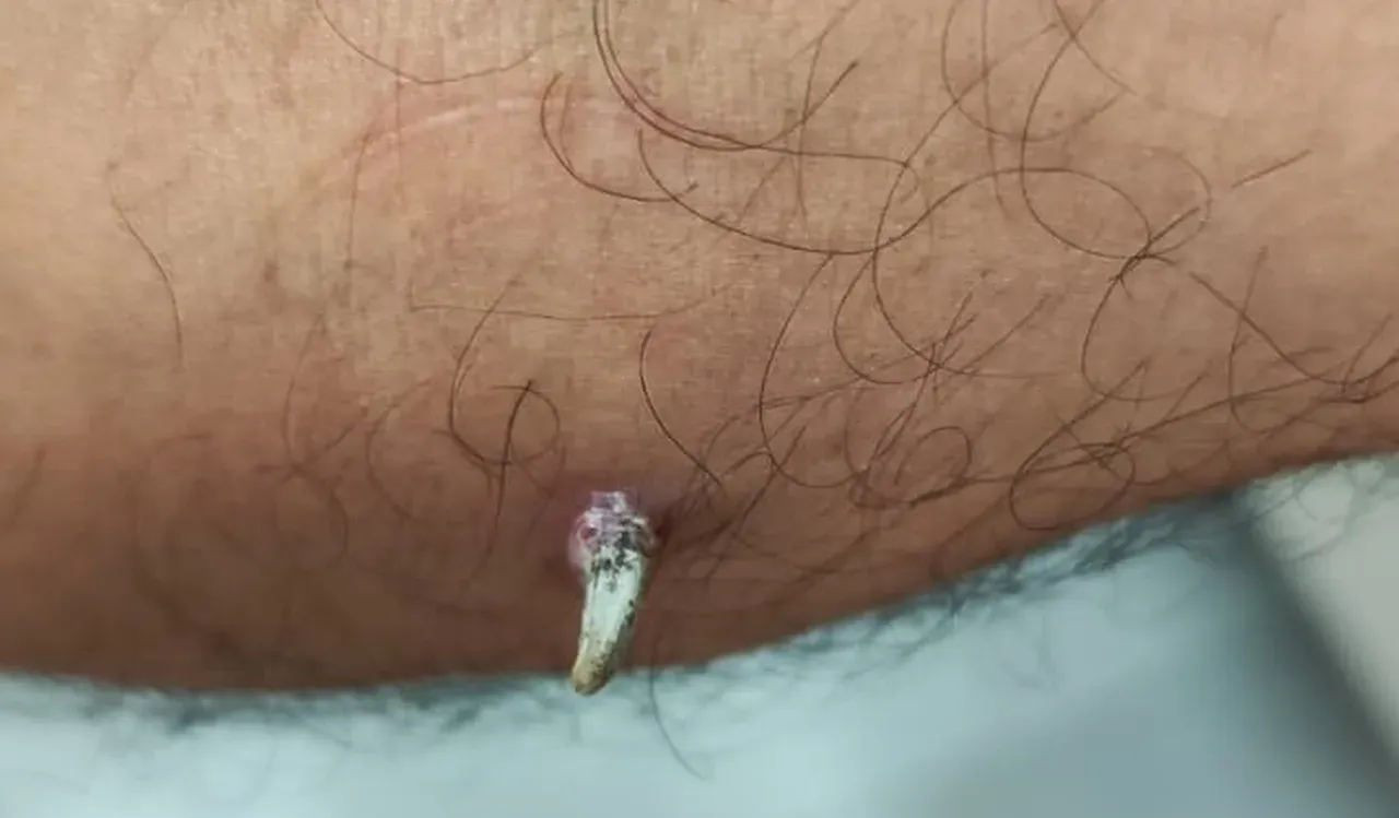 Kolundaki inatçı yarayla başvurdu… Gerçeği doktorda öğrendi