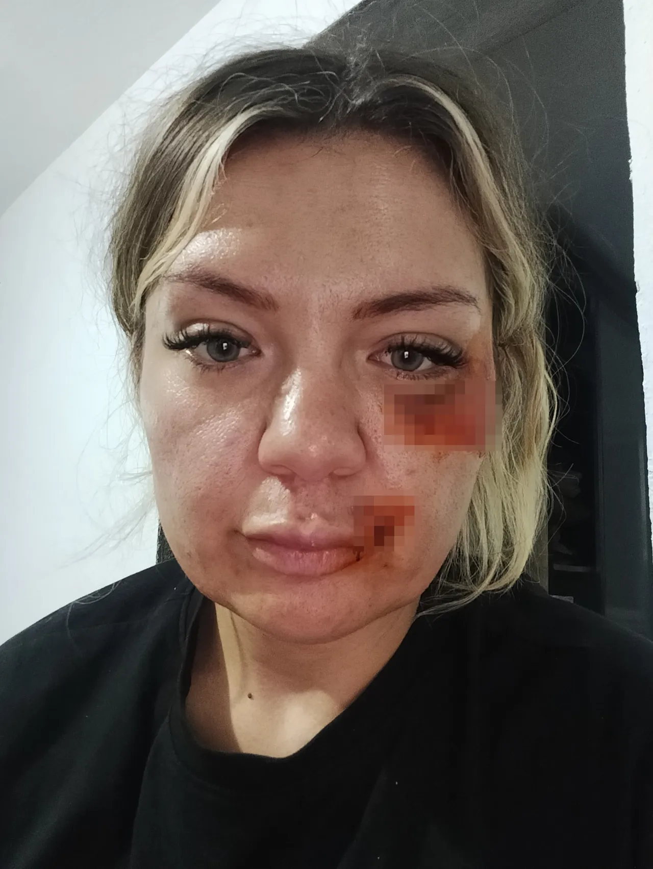 Antalya’da 15 dakikalık dehşet! 30 darbeye rağmen ölümden döndü: Şanslıydım ki bıçak sırtımda kırıldı