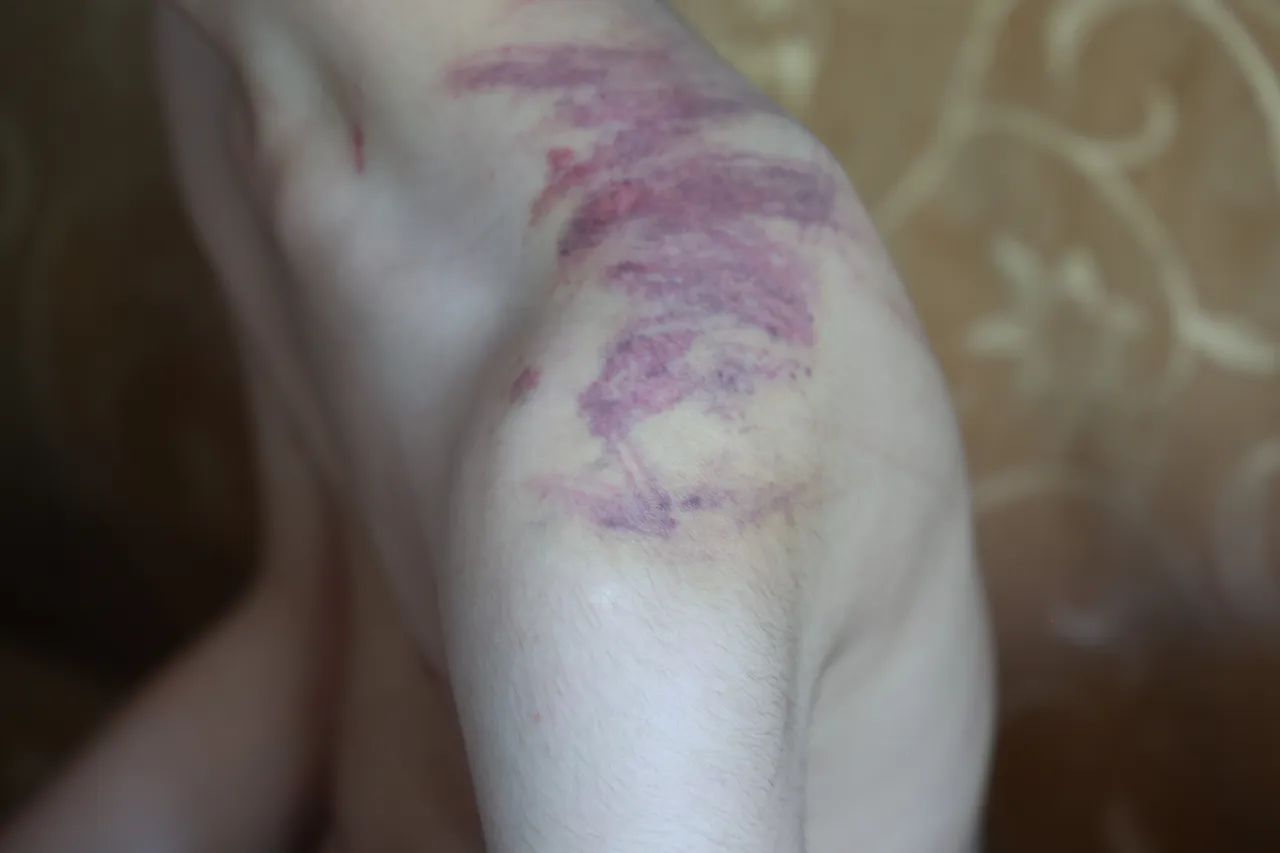 Ense, sırt, omuz… Her yeri mosmor! 14 yaşındaki otizmli çocuğa eğitim merkezinde darp