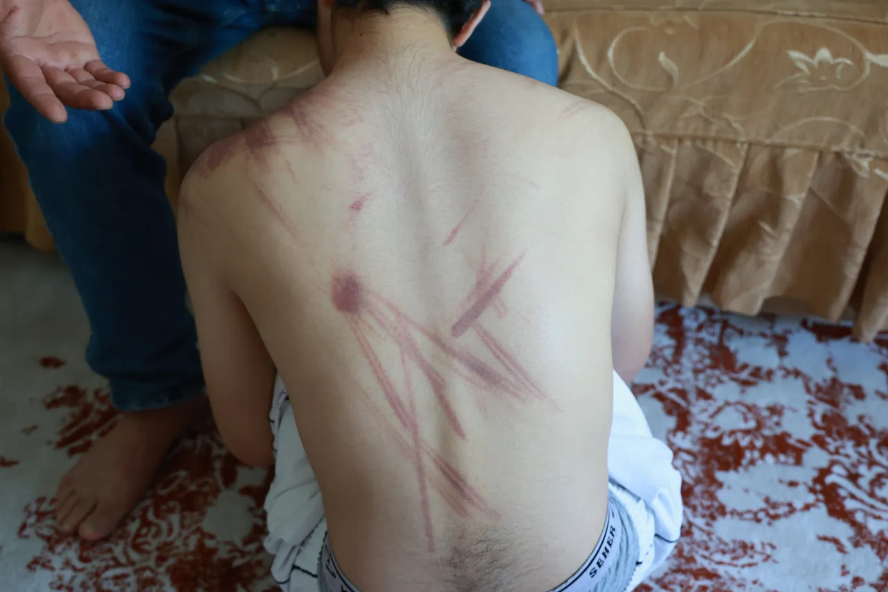 Ense, sırt, omuz… Her yeri mosmor! 14 yaşındaki otizmli çocuğa eğitim merkezinde darp