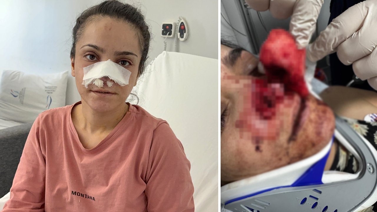 Kocasının ısırarak kopardığı burun yerine dikildi! Korku dolu anları anlattı: Aşağı atlayacaktım