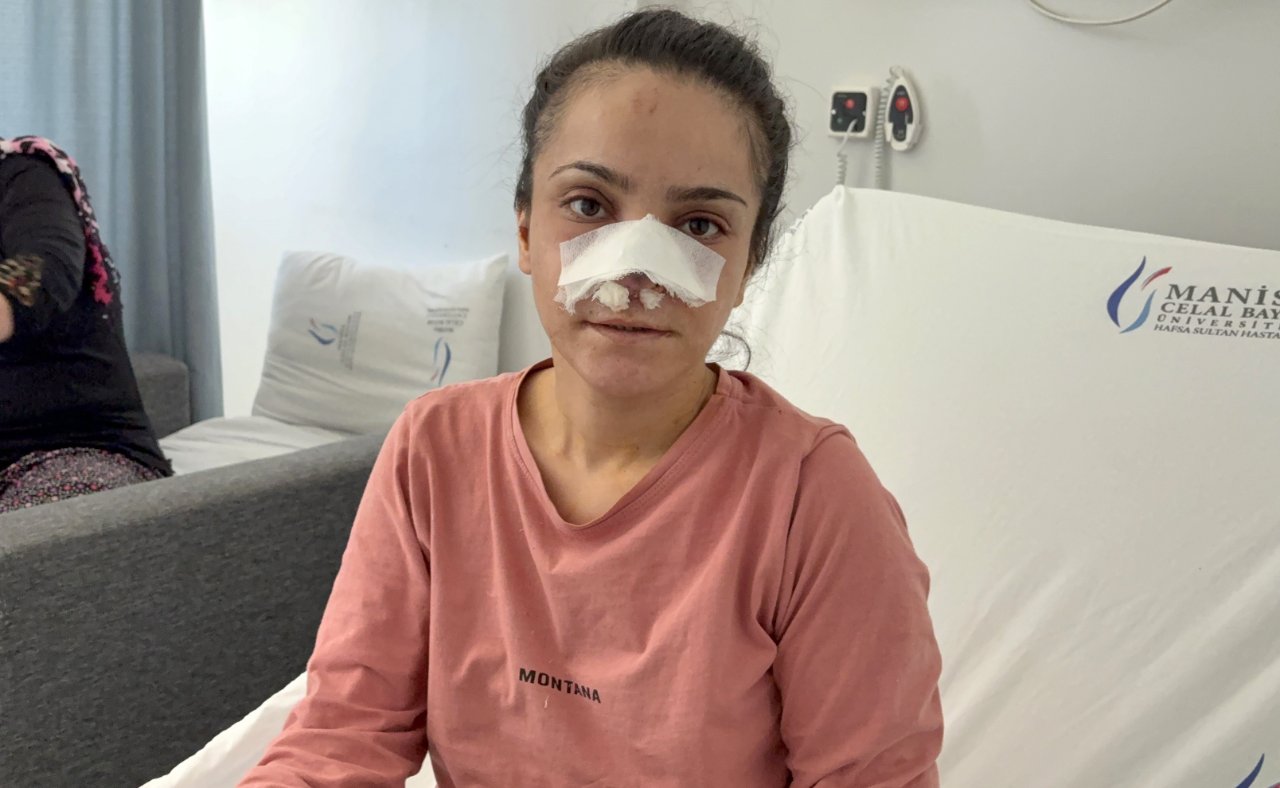 Kocasının ısırarak kopardığı burun yerine dikildi! Korku dolu anları anlattı: Aşağı atlayacaktım