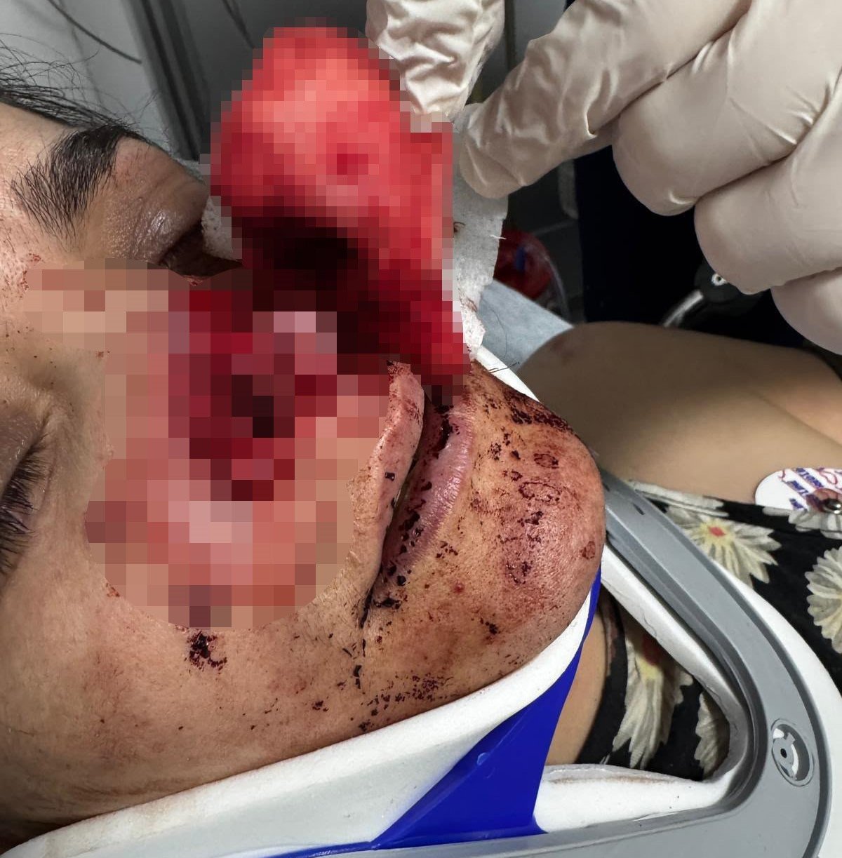 Kocasının ısırarak kopardığı burun yerine dikildi! Korku dolu anları anlattı: Aşağı atlayacaktım