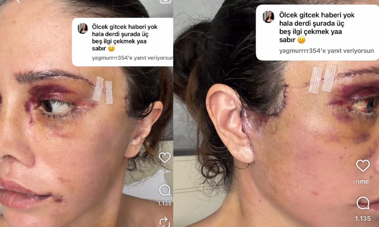 Yüz nakli ameliyatı ile gündemdeydi: Fenomen Didem Ceran ağlayarak anlattı! 