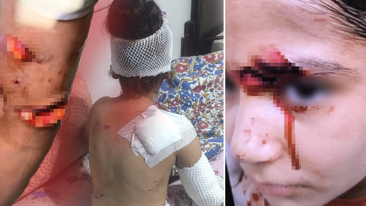 8 köpek birden saldırdı! Şanlıurfa'da dehşet: Çocuğa 150 dikiş atıldı