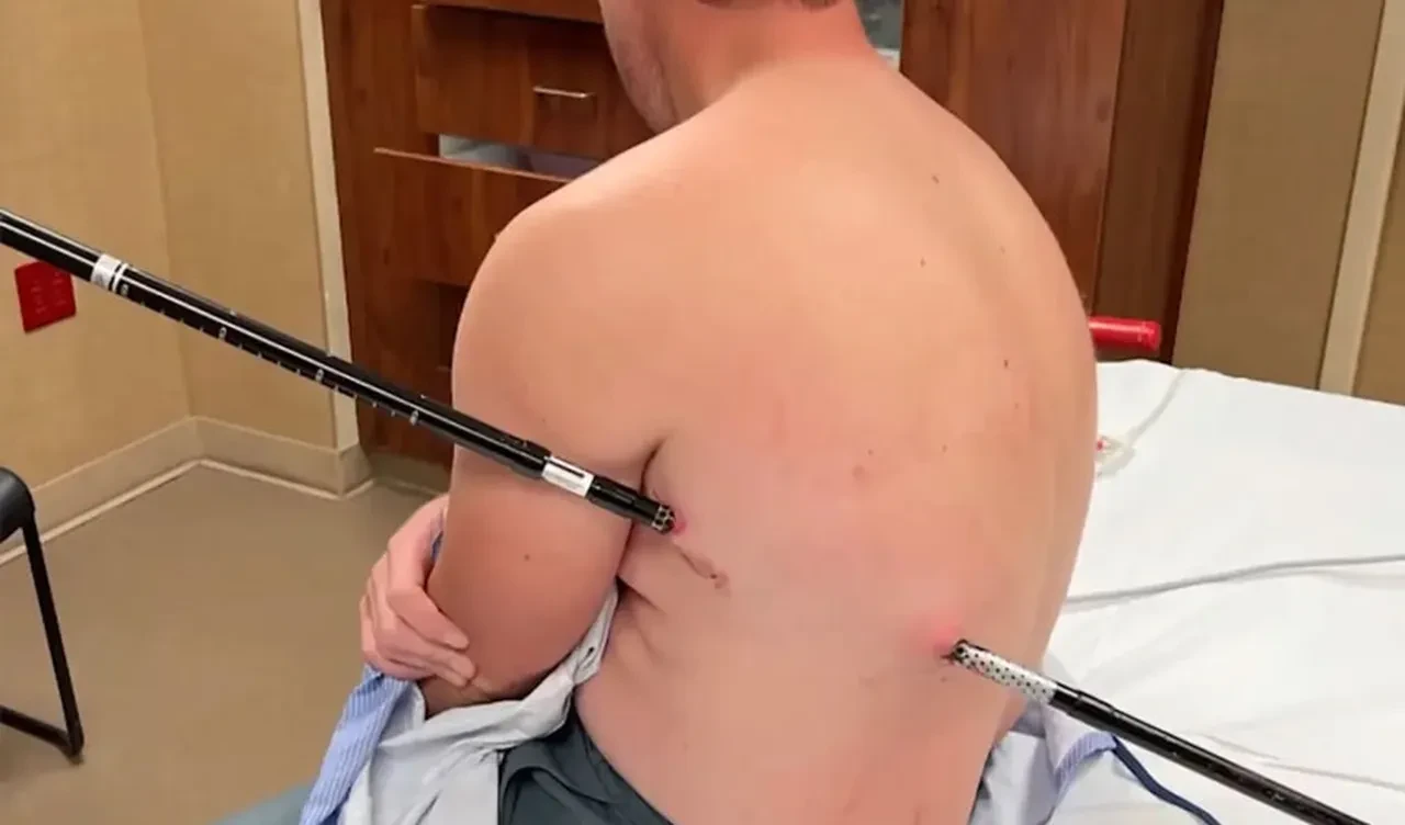 Dağ tırmanışı kabusa döndü! Sırtına saplanan batonla 6 saat yürümüş