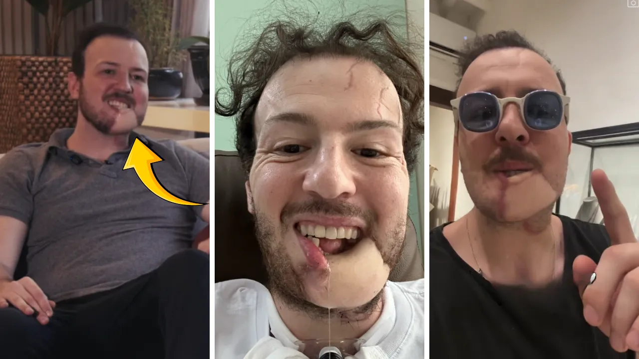 Uğradığı kapkaç sonrası hayatı değişti! 11 kez ameliyat oldu, bacağından parça alınarak çene yapıldı