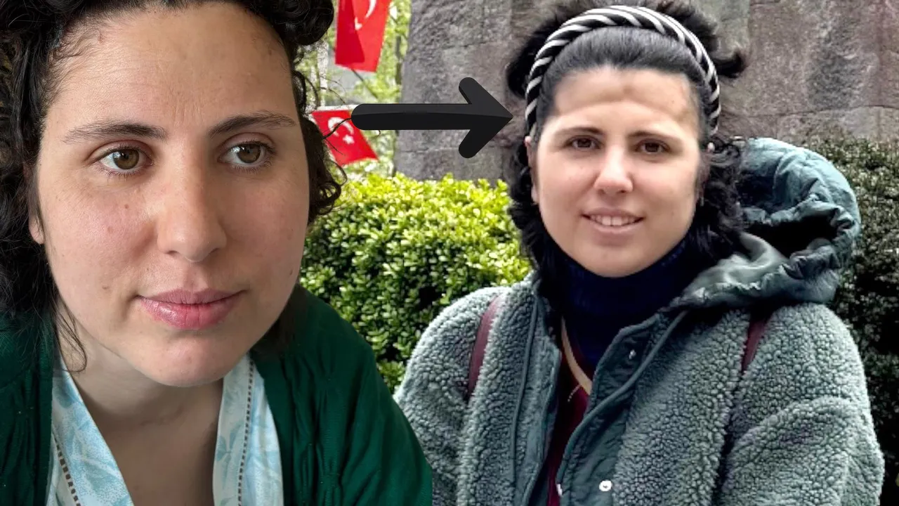Zorlu ameliyatın ardından alnı çöktü! Özel uygulamayla eski haline kavuştu