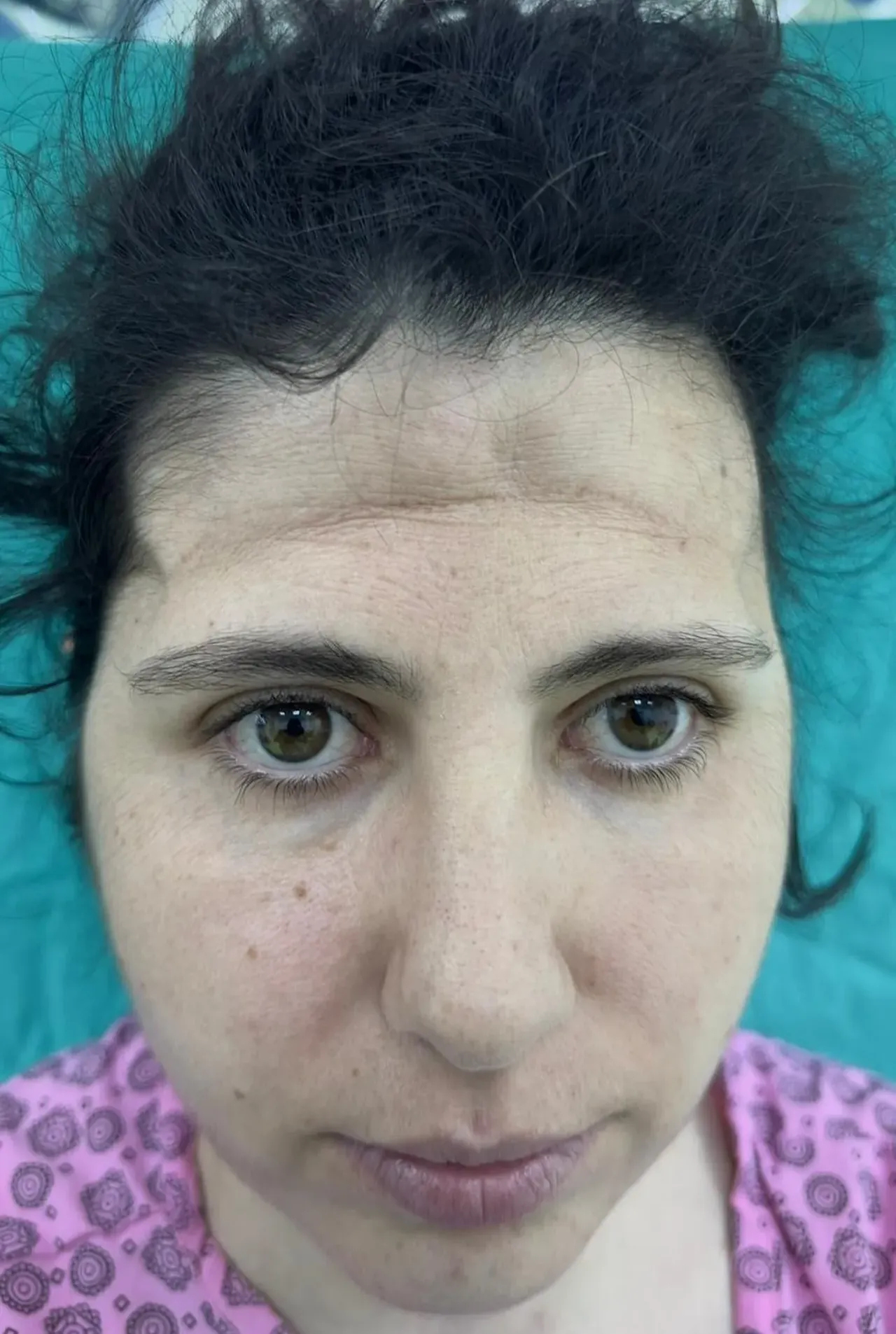 Zorlu ameliyatın ardından alnı çöktü! Özel uygulamayla eski haline kavuştu