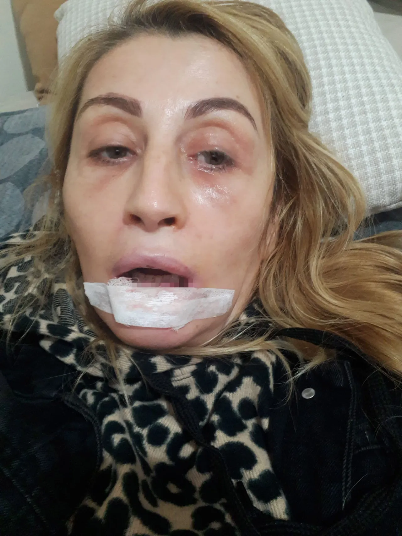Dudağı tamamen çürüdü! Antalya’da özel estetik merkezinde skandal: Tavsiyeyle gitti hayatı karardı