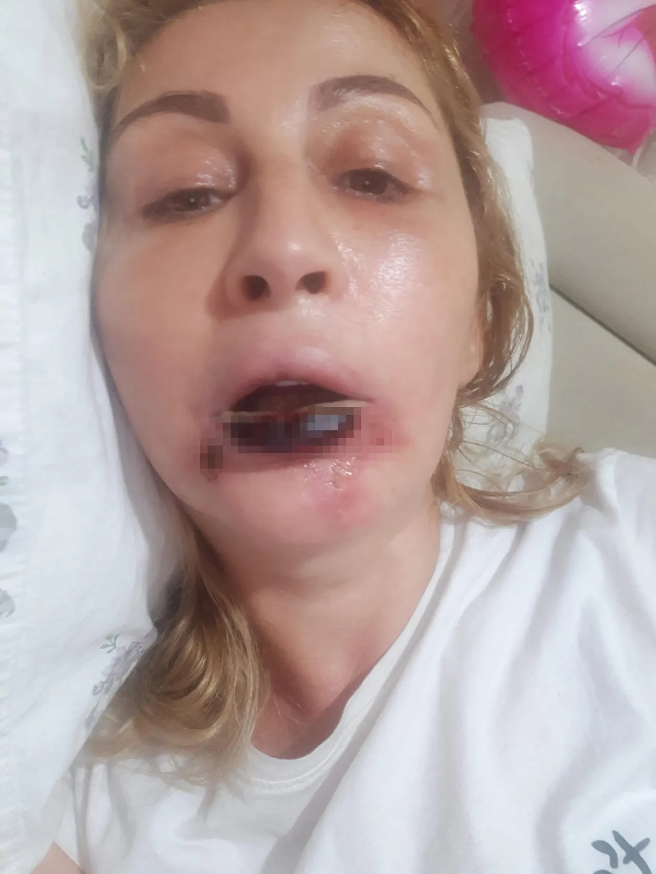 Dudağı tamamen çürüdü! Antalya’da özel estetik merkezinde skandal: Tavsiyeyle gitti hayatı karardı