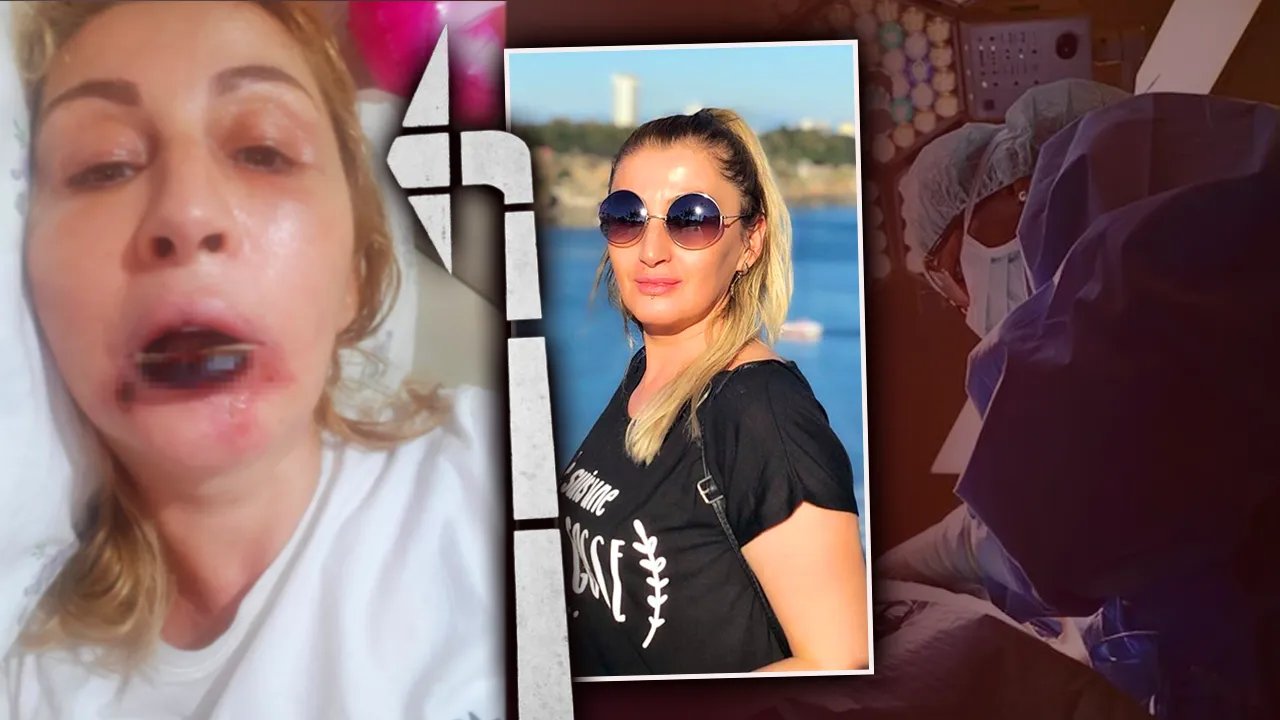 Dudağı tamamen çürüdü! Antalya’da özel estetik merkezinde skandal: Tavsiyeyle gitti hayatı karardı 