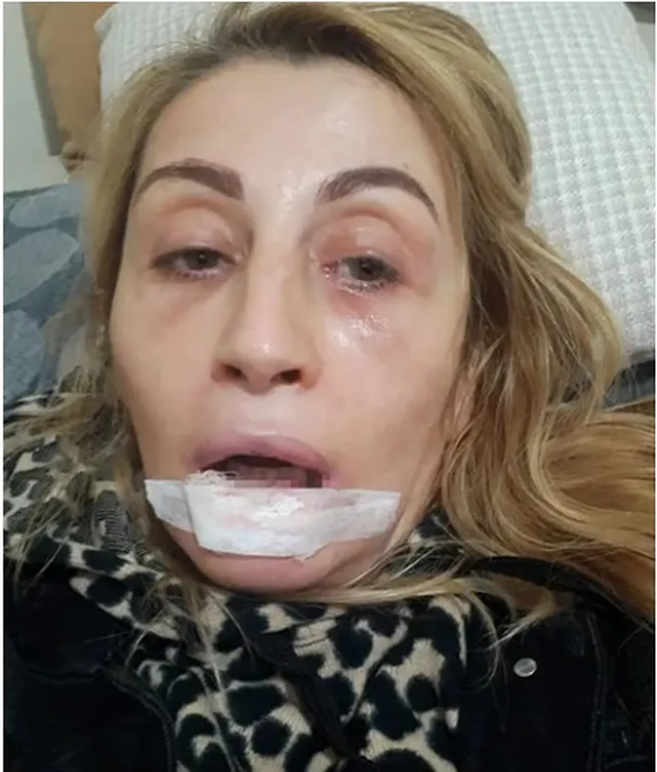 Dudak dolgusu faciası! Uzmanlardan hayat kurtaran  ilk 6 saat  uyarısı