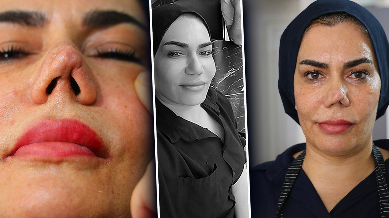 Aynaya bakamaz hale geldi! Burnunun bir ucu farklı, diğer ucu farklı… 2 çocuk annesinin hayatı ameliyatla kabusa döndü 