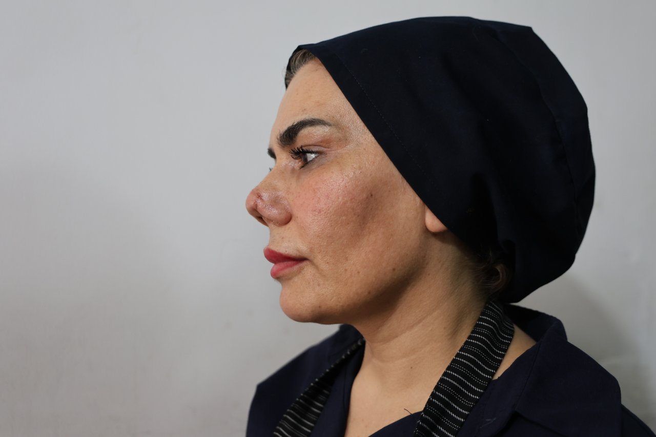 Aynaya bakamaz hale geldi! Burnunun bir ucu farklı, diğer ucu farklı… 2 çocuk annesinin hayatı ameliyatla kabusa döndü