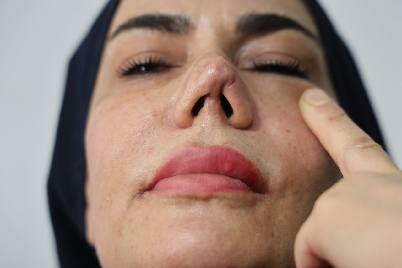 Aynaya bakamaz hale geldi! Burnunun bir ucu farklı, diğer ucu farklı… 2 çocuk annesinin hayatı ameliyatla kabusa döndü