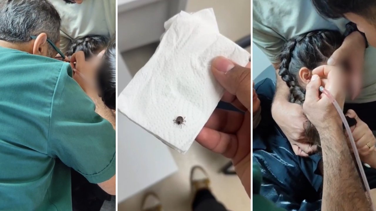Ağrı şikayetiyle hastaneye giden çocuğun kulağından kene çıktı