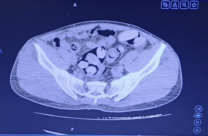 Kırşehirde dikkat çeken operasyon! Midesinden 1 kilo uyuşturucu çıktı